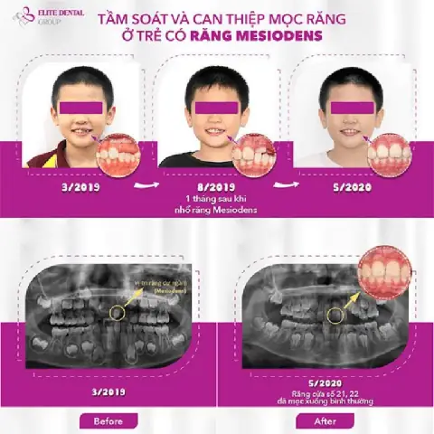 Nha Khoa Cho Bé 2 Tuổi: Chăm Sóc Răng Miệng An Toàn & Hiệu Quả