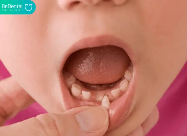 Nhổ Răng Sữa Miễn Phí Cho Bé: Thông Tin Cần Biết & Địa Chỉ Uy Tín